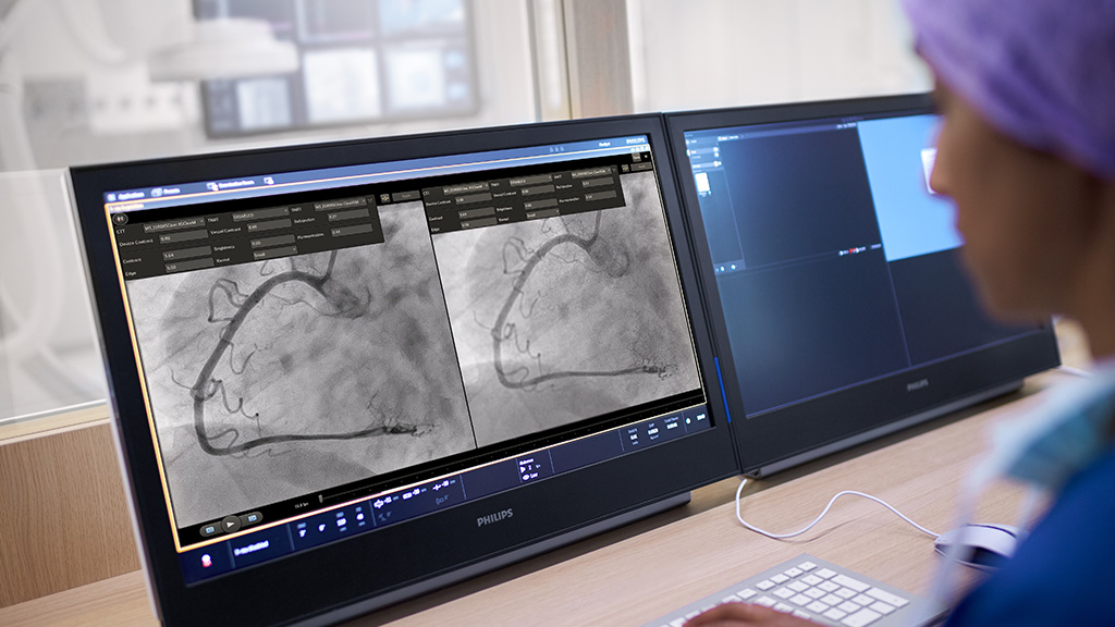 Inovație &icirc;n cardiologie: Philips lansează tehnologia care reduce la jumătate doza de radiație X &icirc;n timpul intervențiilor pe inimă